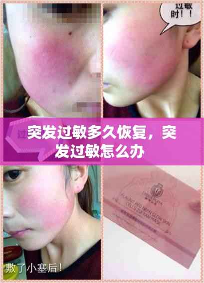 突发过敏多久恢复,突发过敏怎么办